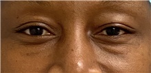 Eyelid Surgery Before Photo by Keshav Magge, MD; Bethesda, MD - Case 47351