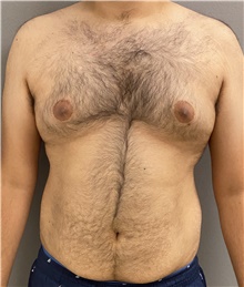 Male Breast Reduction Before Photo by Keshav Magge, MD; Bethesda, MD - Case 47431