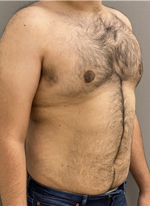 Male Breast Reduction After Photo by Keshav Magge, MD; Bethesda, MD - Case 47431