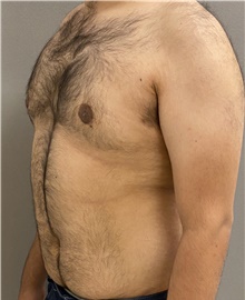 Male Breast Reduction After Photo by Keshav Magge, MD; Bethesda, MD - Case 47431