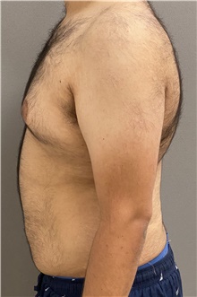 Male Breast Reduction Before Photo by Keshav Magge, MD; Bethesda, MD - Case 47431