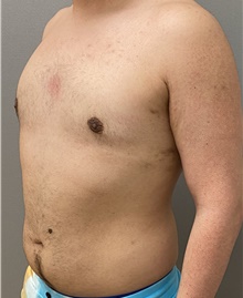 Male Breast Reduction After Photo by Keshav Magge, MD; Bethesda, MD - Case 47433