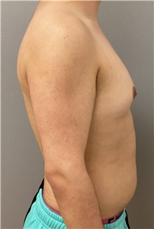 Male Breast Reduction Before Photo by Keshav Magge, MD; Bethesda, MD - Case 47433