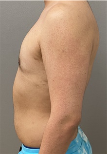 Male Breast Reduction After Photo by Keshav Magge, MD; Bethesda, MD - Case 47433