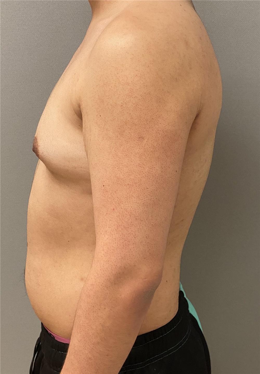Male Breast Reduction Before and After Photos by Keshav Magge, MD; Bethesda,  MD - Case 47433
