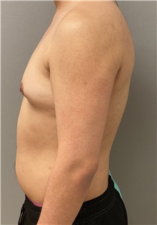 Male Breast Reduction Before Photo by Keshav Magge, MD; Bethesda, MD - Case 47433
