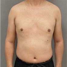Male Breast Reduction After Photo by Keshav Magge, MD; Bethesda, MD - Case 47434