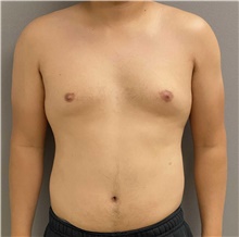 Male Breast Reduction Before Photo by Keshav Magge, MD; Bethesda, MD - Case 47434
