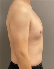 Male Breast Reduction Before Photo by Keshav Magge, MD; Bethesda, MD - Case 47434