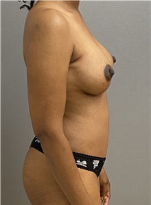 Breast Lift After Photo by Keshav Magge, MD; Bethesda, MD - Case 47507