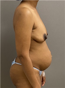 Breast Lift Before Photo by Keshav Magge, MD; Bethesda, MD - Case 47507