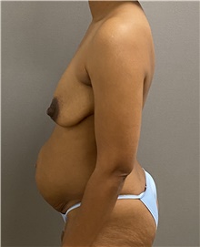 Breast Lift Before Photo by Keshav Magge, MD; Bethesda, MD - Case 47507