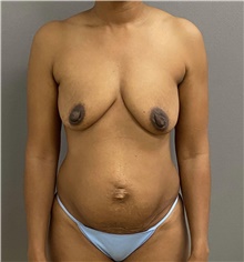 Tummy Tuck Before Photo by Keshav Magge, MD; Bethesda, MD - Case 47508