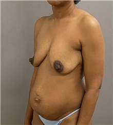 Tummy Tuck Before Photo by Keshav Magge, MD; Bethesda, MD - Case 47508