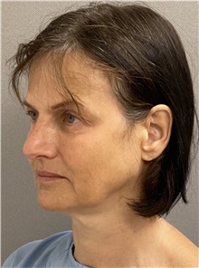 Facelift Before Photo by Keshav Magge, MD; Bethesda, MD - Case 47537