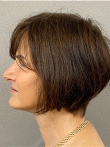 Neck Lift After Photo by Keshav Magge, MD; Bethesda, MD - Case 47538