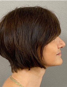 Neck Lift After Photo by Keshav Magge, MD; Bethesda, MD - Case 47538