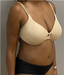 Tummy Tuck After Photo by Keshav Magge, MD; Bethesda, MD - Case 47539