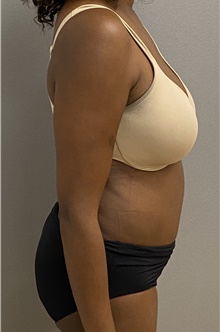 Tummy Tuck After Photo by Keshav Magge, MD; Bethesda, MD - Case 47539