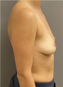 Breast Augmentation Before Photo by Keshav Magge, MD; Bethesda, MD - Case 47540