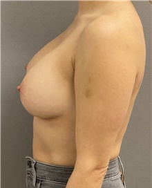 Breast Augmentation After Photo by Keshav Magge, MD; Bethesda, MD - Case 47540
