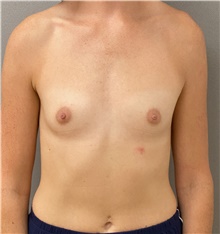 Breast Augmentation Before Photo by Keshav Magge, MD; Bethesda, MD - Case 47590