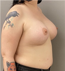 Breast Augmentation After Photo by Keshav Magge, MD; Bethesda, MD - Case 47591
