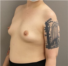 Breast Augmentation Before Photo by Keshav Magge, MD; Bethesda, MD - Case 47591