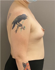 Breast Augmentation Before Photo by Keshav Magge, MD; Bethesda, MD - Case 47591