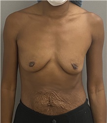 Breast Augmentation Before Photo by Keshav Magge, MD; Bethesda, MD - Case 47592