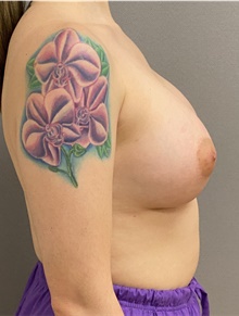 Breast Augmentation After Photo by Keshav Magge, MD; Bethesda, MD - Case 47593