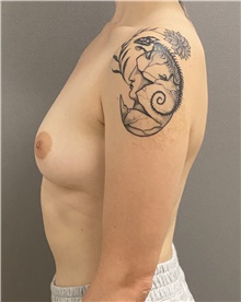 Breast Augmentation Before Photo by Keshav Magge, MD; Bethesda, MD - Case 47593
