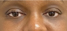 Eyelid Surgery After Photo by Keshav Magge, MD; Bethesda, MD - Case 47594