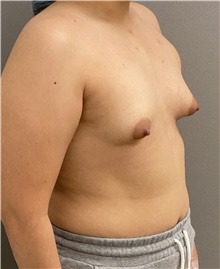 Breast Augmentation Before Photo by Keshav Magge, MD; Bethesda, MD - Case 47595
