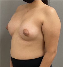 Breast Augmentation After Photo by Keshav Magge, MD; Bethesda, MD - Case 47595
