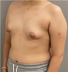 Breast Augmentation Before Photo by Keshav Magge, MD; Bethesda, MD - Case 47595