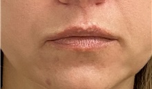 Lip Augmentation/Enhancement After Photo by Keshav Magge, MD; Bethesda, MD - Case 47596
