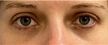 Eyelid Surgery After Photo by Keshav Magge, MD; Bethesda, MD - Case 47597