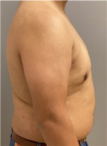 Male Breast Reduction After Photo by Keshav Magge, MD; Bethesda, MD - Case 47598