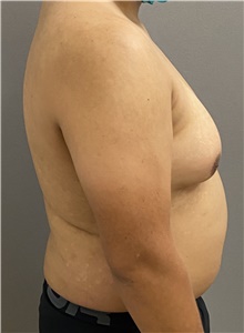 Male Breast Reduction Before Photo by Keshav Magge, MD; Bethesda, MD - Case 47598