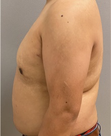 Male Breast Reduction After Photo by Keshav Magge, MD; Bethesda, MD - Case 47598
