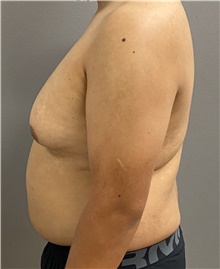 Male Breast Reduction Before Photo by Keshav Magge, MD; Bethesda, MD - Case 47598