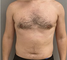 Male Breast Reduction After Photo by Keshav Magge, MD; Bethesda, MD - Case 47599