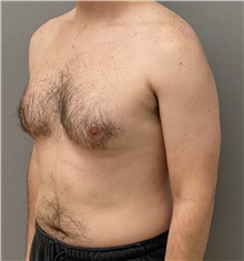 Male Breast Reduction Before Photo by Keshav Magge, MD; Bethesda, MD - Case 47599