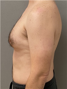 Male Breast Reduction Before Photo by Keshav Magge, MD; Bethesda, MD - Case 47599