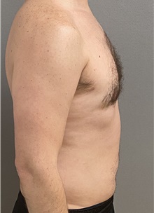 Male Breast Reduction After Photo by Keshav Magge, MD; Bethesda, MD - Case 47599