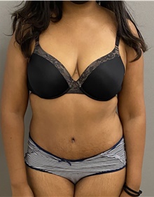 Tummy Tuck After Photo by Keshav Magge, MD; Bethesda, MD - Case 47600