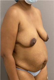 Tummy Tuck Before Photo by Keshav Magge, MD; Bethesda, MD - Case 47600