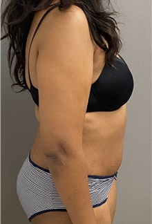 Tummy Tuck After Photo by Keshav Magge, MD; Bethesda, MD - Case 47600