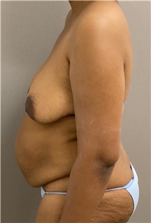 Tummy Tuck Before Photo by Keshav Magge, MD; Bethesda, MD - Case 47600